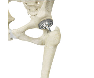 Total Hip Replacement 