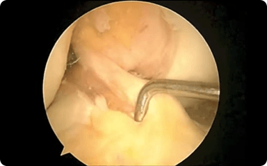 Picture of ACL Reconstruction