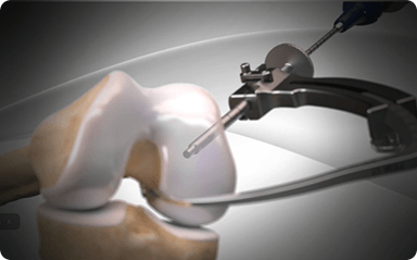 Picture of All-Inside ACL Reconstruction