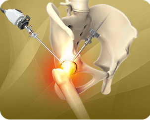 Picture of Hip Arthroscopy
