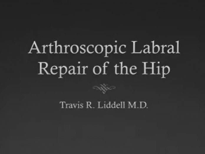 Picture of Hip Scope Labral Repair