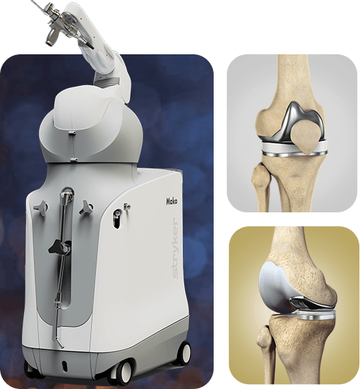 Picture of Joint Replacement