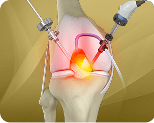 Picture of Knee Arthroscopy