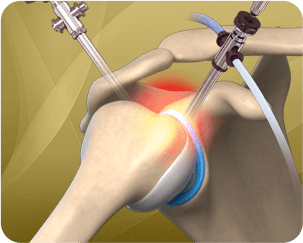 Picture of Shoulder Arthroscopy