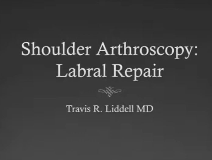 Picture of Shoulder 360 Labral Repair Video