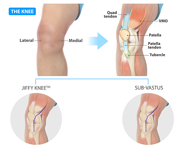 Surgical approach used during Jiffy Knee” and “Muscle Sparing Subvastus Approach