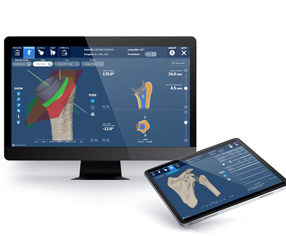 Picture of Total Shoulder Arthroplasty