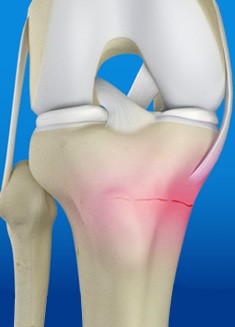 Fracture Care