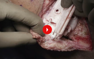 Custom Biplanar High Tibial Osteotomy after a Failed Multiligament Reconstruction