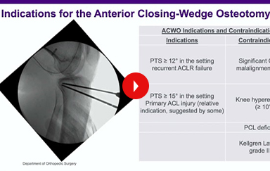 ACL Reconstruction with Posterolateral corner (PLC)  Reconstruction