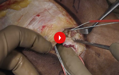 Posterior Cruciate Ligament and Posterolateral Corner Reconstruction