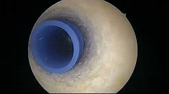 Single Stage Multiligament Reconstruction of a Chronic ACL PCL and MCL Injury sp
