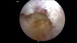 Staged Reconstruction of a Multiligamentous Knee Injury - ACL, PCL, LCL sp