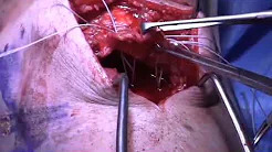 Transosseous Equivalent Repair for Distal Patellar Tendon Avulsion sp
