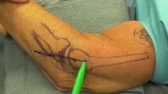 Lateral Ulnar Collateral Ligament Reconstruction for Posterolateral Rotatory Instability sp