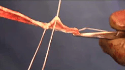 Coracoclavicular Reconstruction with Tibialis Anterior Allograft and Dogbone Fixation sp