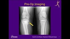 Revision Medial Opening Wedge High Tibial Osteotomy sp