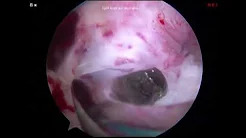 Meniscal Allograft Transplantation made simple A how to guide PART 3 sp