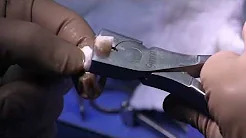 Meniscal Allograft Transplantation made simple A how to guide PART 2 sp