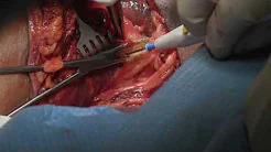 Displaced Posterior Cruciate Avulsion Fracture Fixation with Medial Collateral Ligament Repair sp