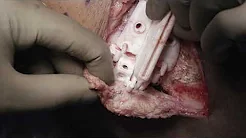 Custom Biplanar High Tibial Osteotomy after a Failed Multiligament Reconstruction sp