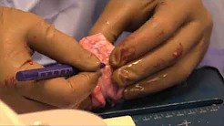 Osteochondral Proximal Tibial and Lateral Meniscal Allograft Transplant sp