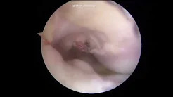 Combined Anterior Opening Wedge High Tibial Osteotomy and Tibial Tubercle Osteotomy sp