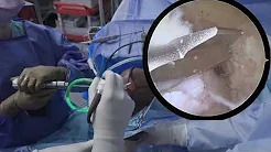 AAOS OVT 2022 Aberrant PLC Anatomy sp