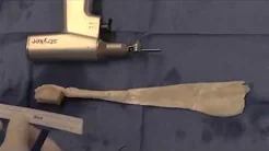 Chronic Patellar Tendon Reconstruction after Failure sp