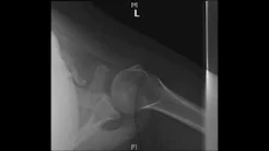 Open Reduction and Internal Fixation of Type III Scapula Fracture sp
