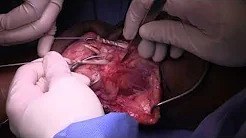 Chronic Quadriceps Tendon Rupture Reconstruction NYU Hospitals for Joint Diseases sp