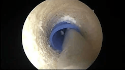 PCL Reconstruction in an athlete with a Multiligament Knee Injury NYU hospital for Joint Disease sp