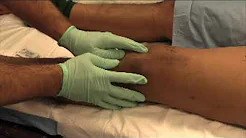 Revision Lateral Femoral Condyle ORIF with Quadricepsplasty and MPFL Reconstruction sp