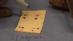 Arthroscopic Rotator Cuff Repair with Dermal Collagen Allograft Patch sp