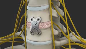 Anterior Cervical Discectomy and Fusion (ACDF)