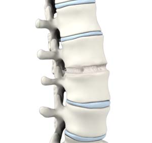 Anterior Lumbar Interbody Fusion (ALIF)