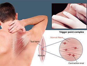 Systemic Dry Needling