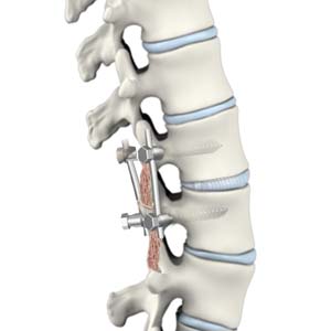 Transforaminal Lumbar Interbody Fusion (TLIF/PLIF)