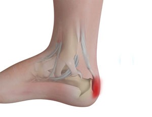 Insertional Achilles Debridement (Spur Removal) and Repair