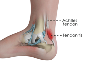 Achilles Tendonitis pic