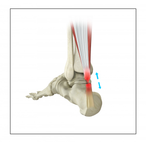 Achilles Tendon Reconstruction
