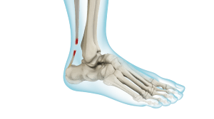 Achilles Tendon Rupture pic