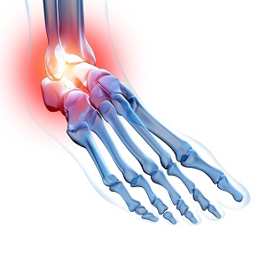 Ankle Pain pic