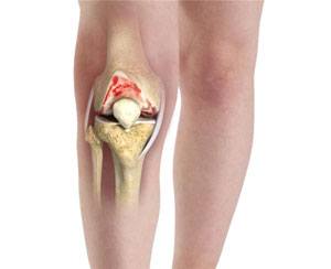 Arthritis Surgery