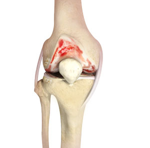 Arthritis pic