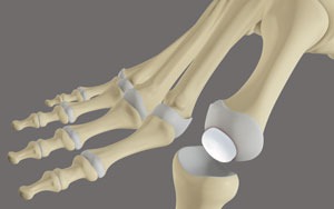 Big Toe Motion Preservation Surgery