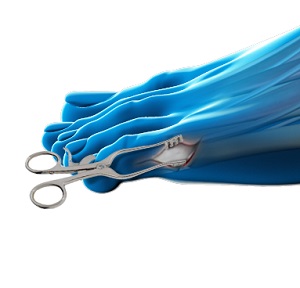 Bunionette Surgery