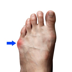 Bunionette (Tailor's Bunion) pic