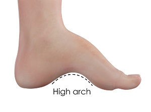 Cavus Foot Deformity (High Arches)