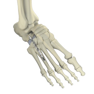 Charcot Reconstruction